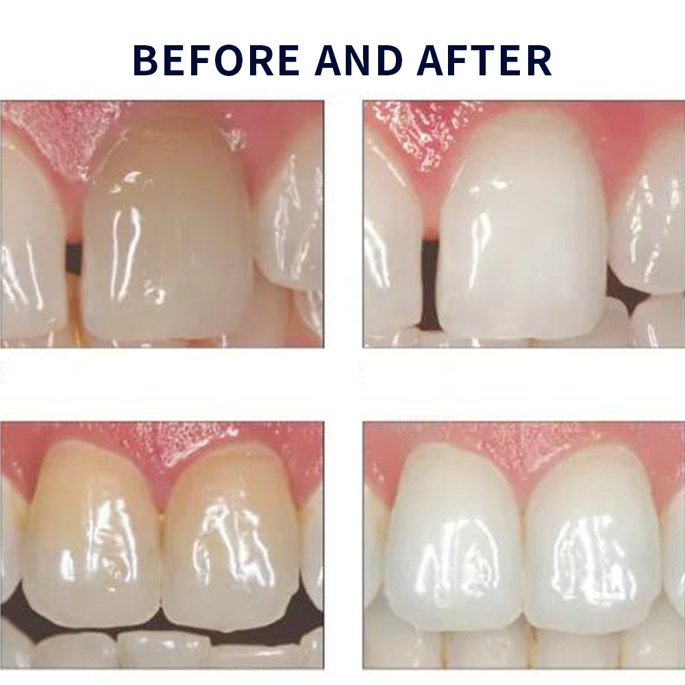 Opalescence Whitening 20% PF 2 - Teeth Whitening In Office reseña y precio