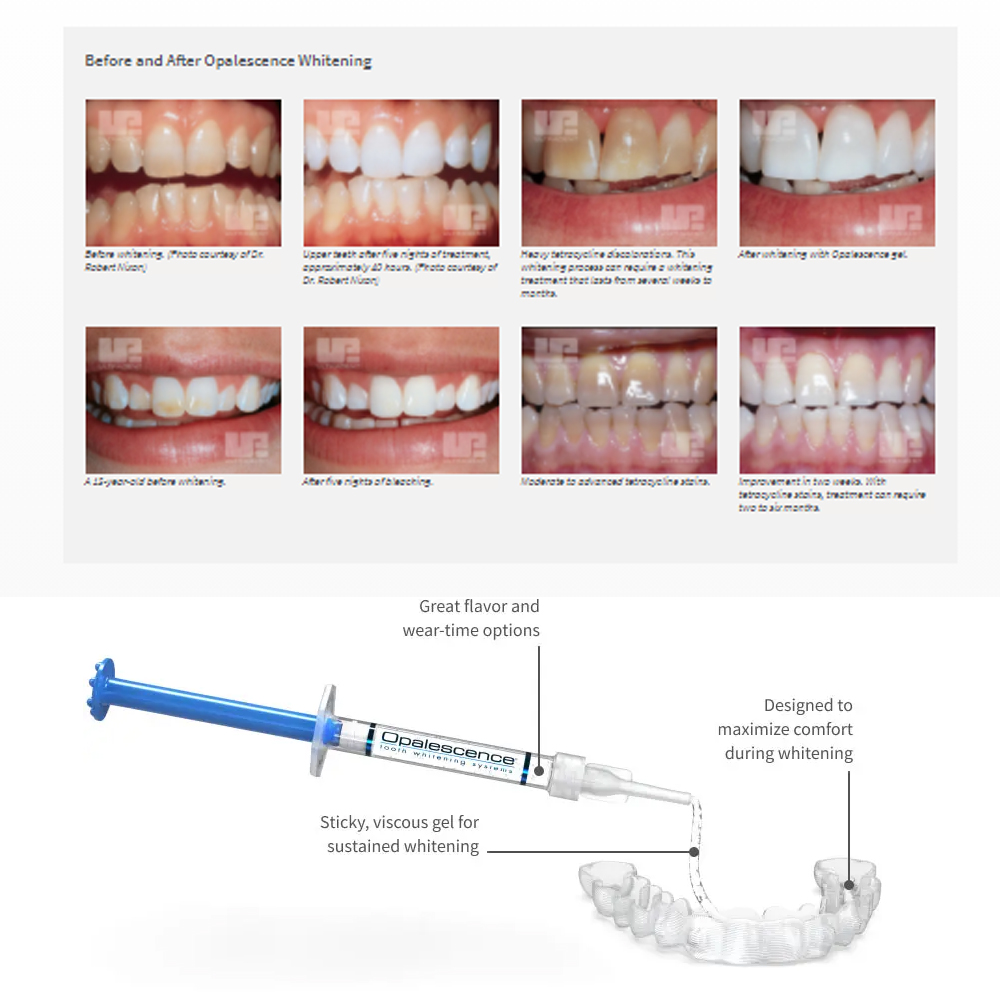 Opalescence Whitening 20% PF 2 - Teeth Whitening In Office reseña y precio
