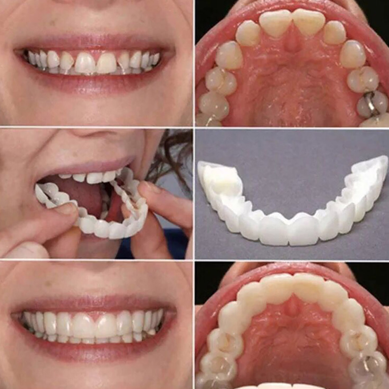 Daily Commute Teeth Veneers, T - Teeth Whitening In Office reseña y precio