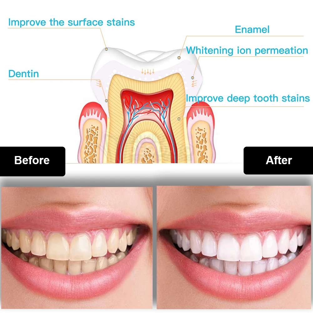 Dental Teeth Whitening Kit Min - Teeth Whitening Q&M reseña y precio