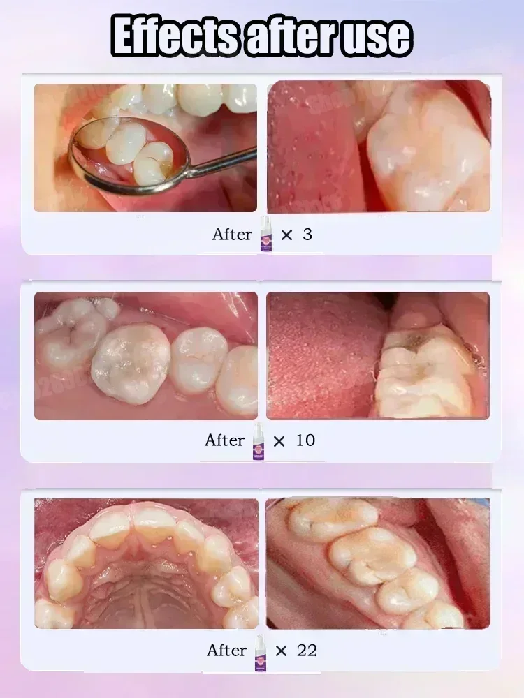 Teeth Cleaning Toothpaste Remo - Teeth Whitening Treatment reseña y precio
